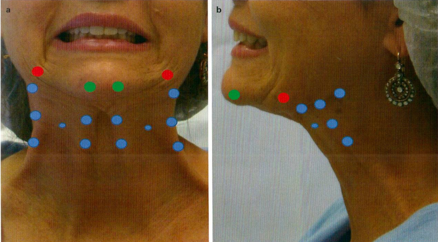 图6-3(a,b)下颌轮廓治疗的注射点位.