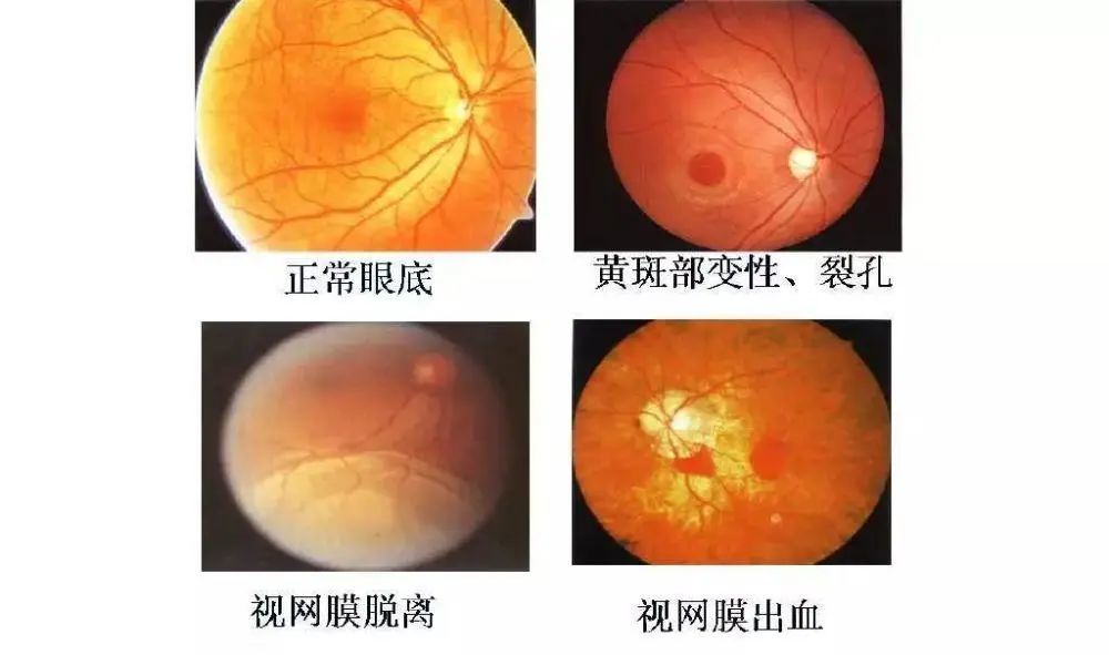 高度近视的五大并发症之一—视网膜脱落