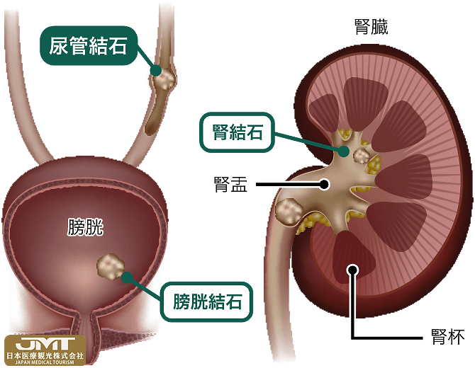 jmt日本医疗-与生活习惯病有关的尿道结石,有时会产生剧烈疼痛