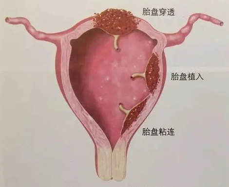 胎盘植入是指 胎盘绒毛侵入子宫肌层