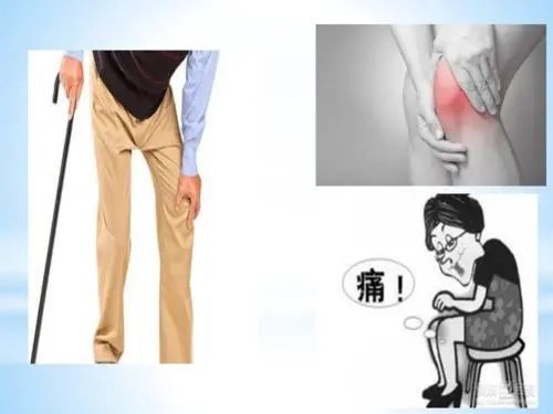 膝关节骨性关节炎有什么症状?