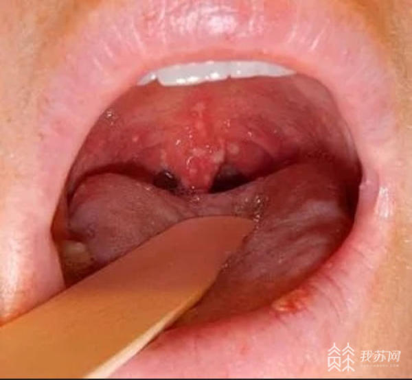 家长们注意了:疱疹性咽颊炎已到高发季