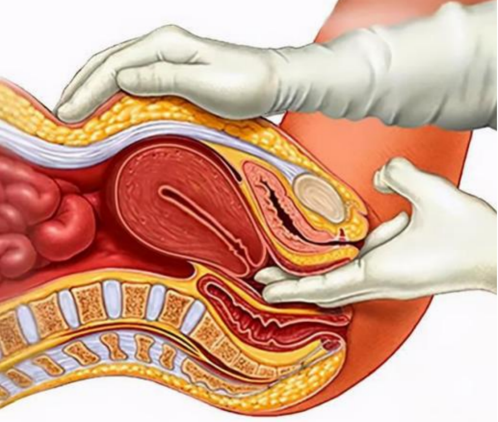 三合诊能更清楚地了解,位于骨盆后部及直肠子宫陷凹部肿物与子宫或