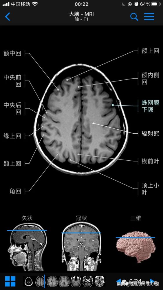 【高清mri图】颅脑磁共振mri解剖