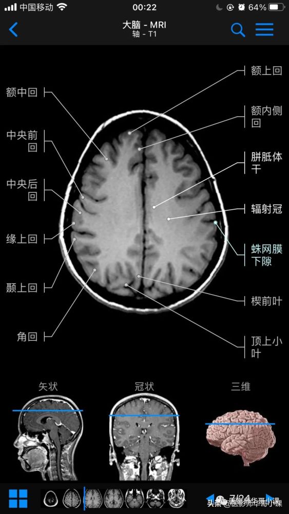 【高清mri图】颅脑磁共振mri解剖