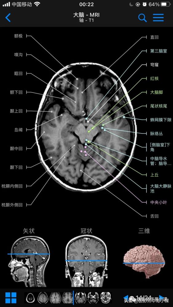 高清mri图颅脑磁共振mri解剖