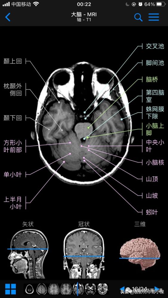 【高清mri图】颅脑磁共振mri解剖