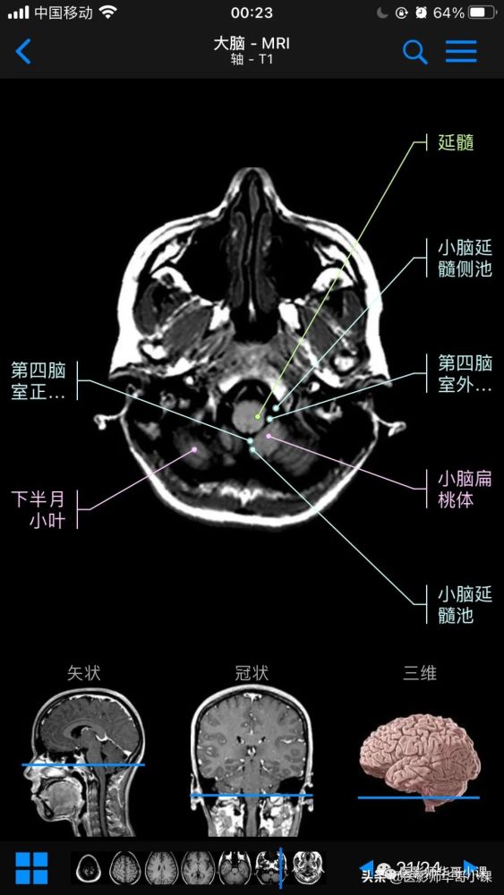【高清mri图】颅脑磁共振mri解剖