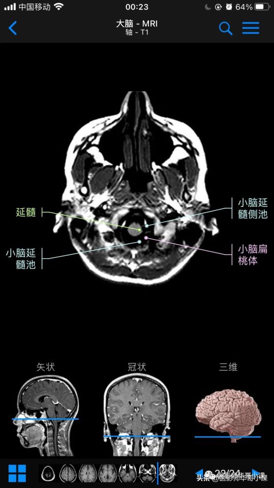 【高清mri图】颅脑磁共振mri解剖