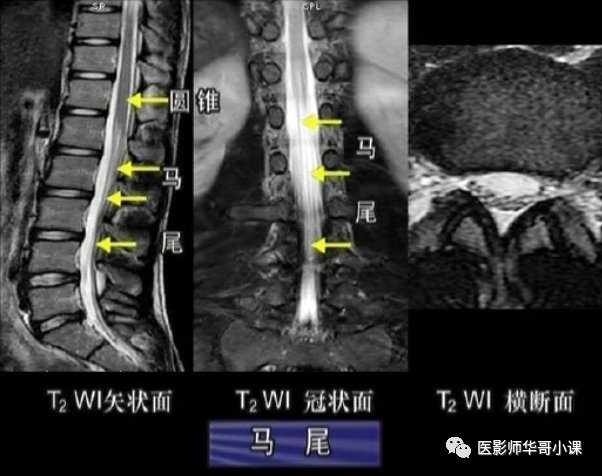 【高清mri图】脊柱磁共振mri解剖