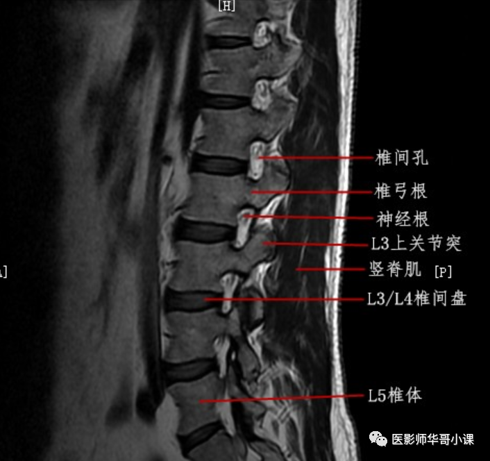 【高清mri图】脊柱磁共振mri解剖