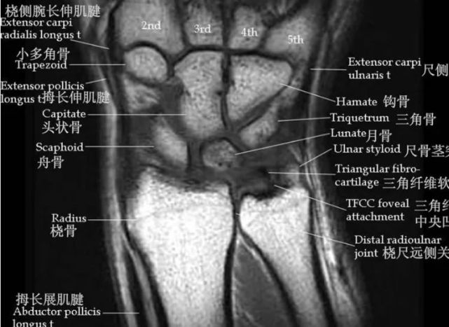 【高清mri图】腕关节磁共振mri解剖