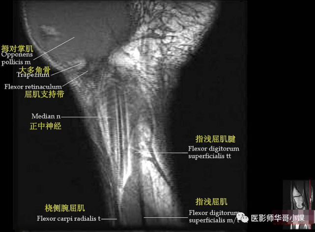 【高清mri图】腕关节磁共振mri解剖