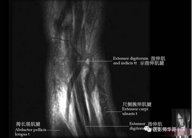 【高清mri图】腕关节磁共振mri解剖