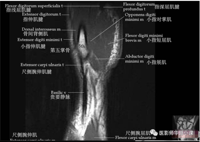 【高清mri图】腕关节磁共振mri解剖