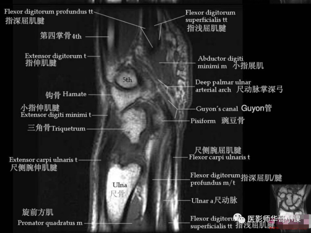 【高清mri图】腕关节磁共振mri解剖