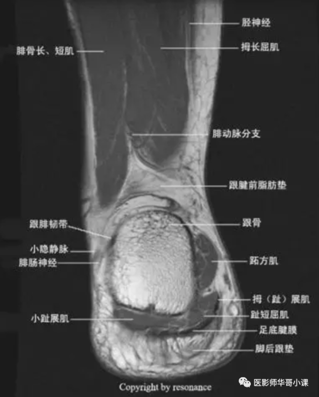 【高清mri图】踝关节磁共振mri解剖