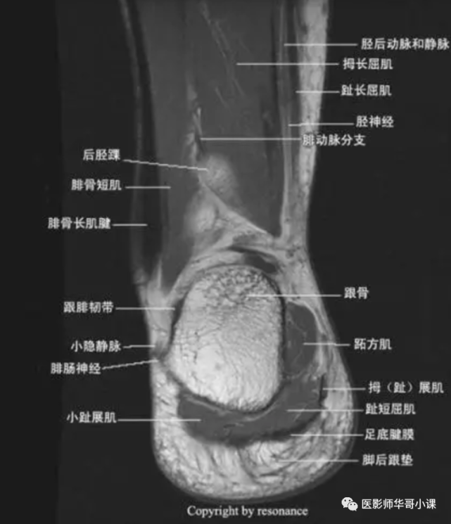 【高清mri图】踝关节磁共振mri解剖