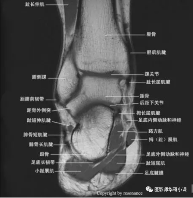 【高清mri图】踝关节磁共振mri解剖