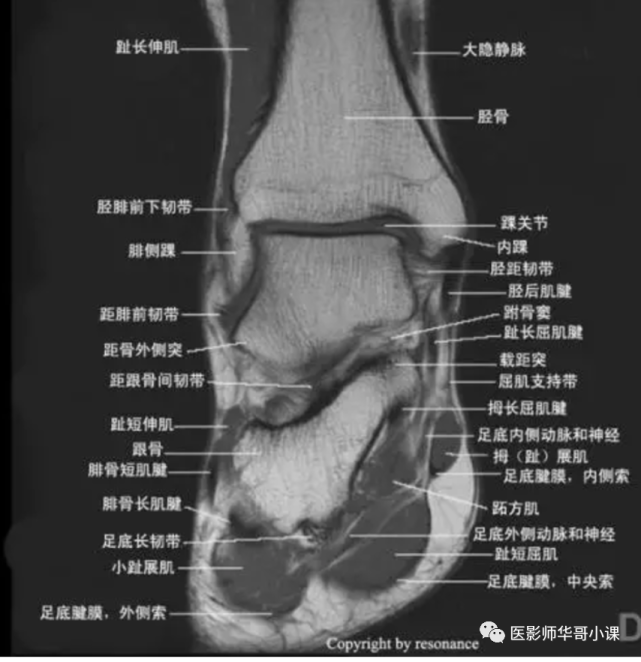 【高清mri图】踝关节磁共振mri解剖