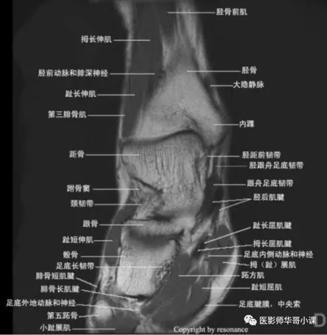 【高清mri图】踝关节磁共振mri解剖