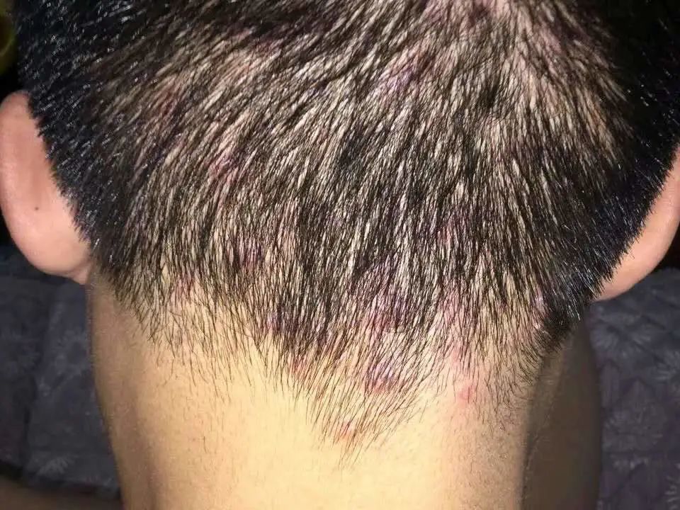 头皮频频长出痘痘疙瘩警惕3大疾病