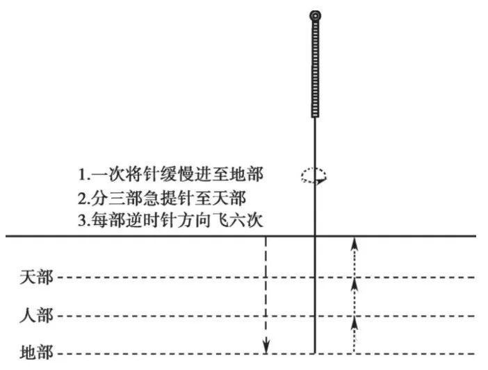 针灸补和泻是什么原理_针灸补泻手法图解(2)