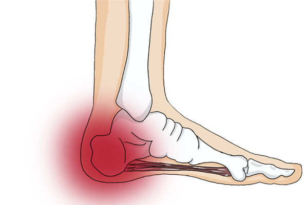 脚踝疼痛,和什么因素有关?该怎么办?医生为您详解