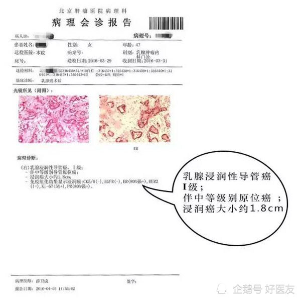 如上图所示,该患者病理诊断结果为乳腺浸润性导管癌l级