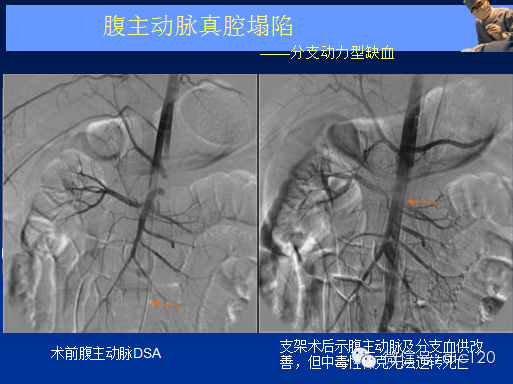 主动脉夹层,壁间血肿及穿通性溃疡