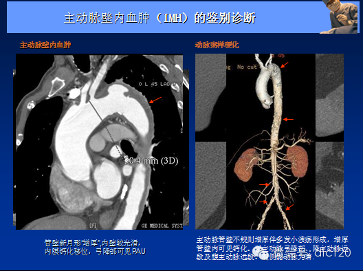 主动脉夹层,壁间血肿及穿通性溃疡
