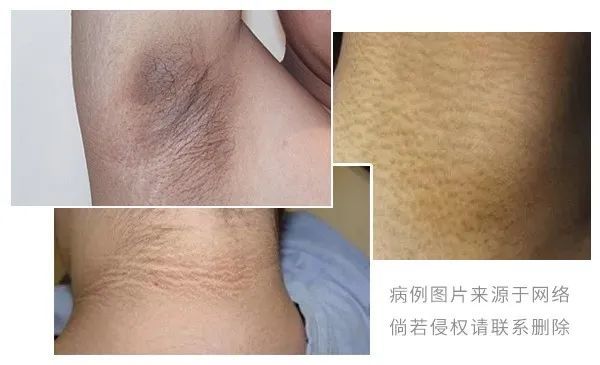 脖子黑黑的洗不掉?皮肤科医生来告诉你!