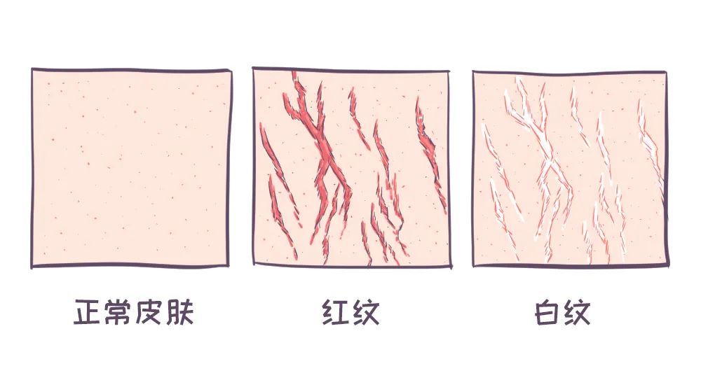 身上的这种纹没怀孕也会有4招可改善