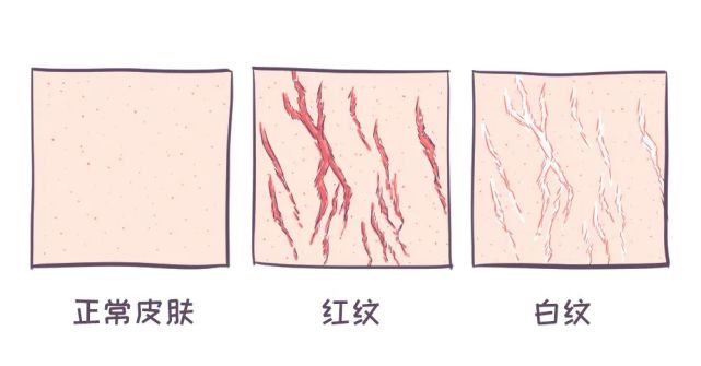 至紫色它的出现是一个变化过程:从外观分:红纹,白纹膨胀纹一般分布
