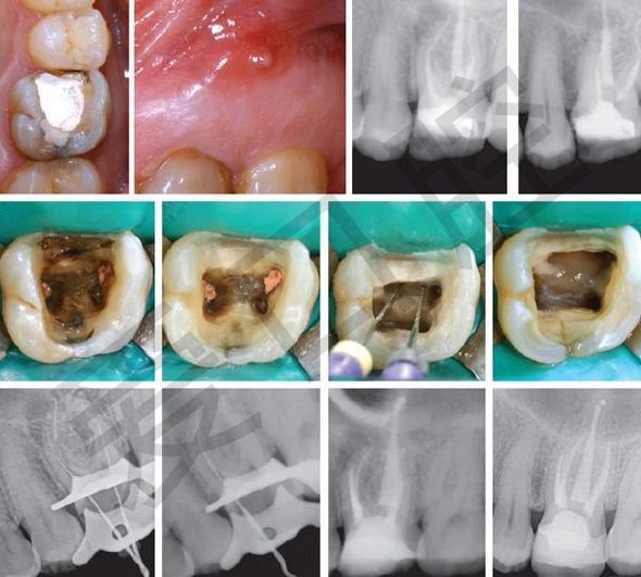 一,根尖骨质破坏≤1～5mm牙齿松动度≤Ⅱ度无窦道形成的慢性根尖周炎