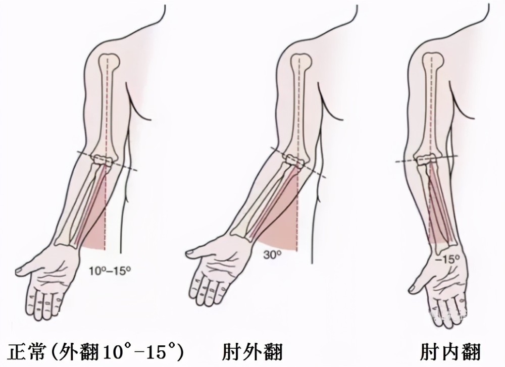 文根四肢矫形科普系列肘关节畸形怎么办截骨矫形不置换