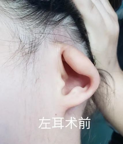3岁孩子没有耳朵医生手术让耳朵重新长出来