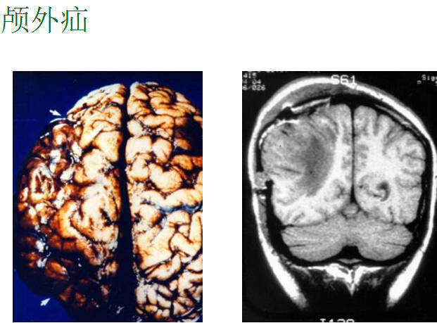 图解脑疝--来自北京天坛神内的杰作