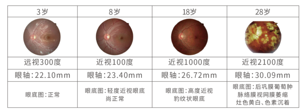 王凯医生视光课堂 | 全飞秒手术在角膜上做,为什么还要查眼底?