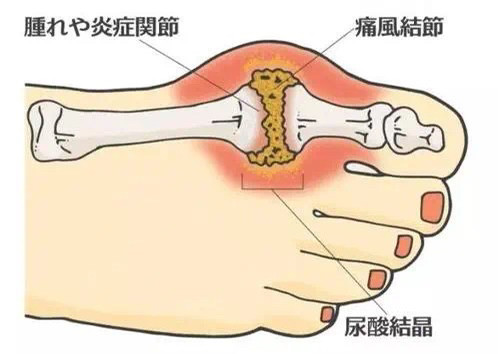 痛风发作时腿一直发胀疼痛怎么办痛风药副作用有哪些