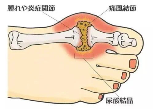 痛风发作时腿一直发胀疼痛怎么办?痛风药副作用有哪些