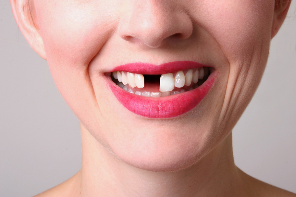 牙齿缺失后,牙弓形态和咬合错位,面部和唇颊部易坍塌畸形.