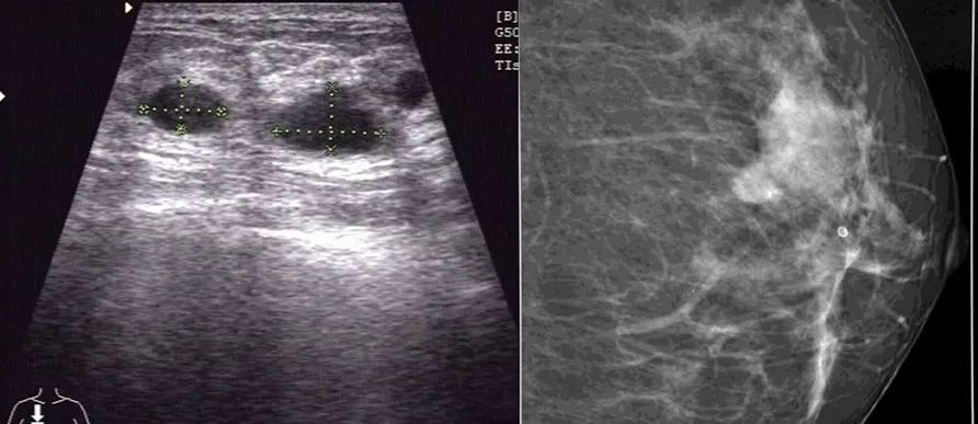 明明做了乳腺超声检查为啥还需要到放射科做乳腺钼靶