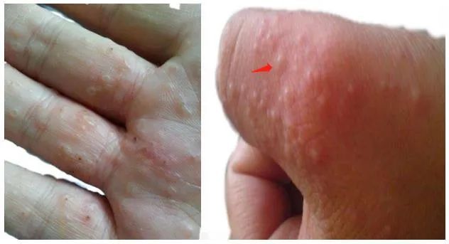 角质增生性手湿疹在手掌部或指部有片状皮肤肥厚,干燥,脱屑,皲裂等