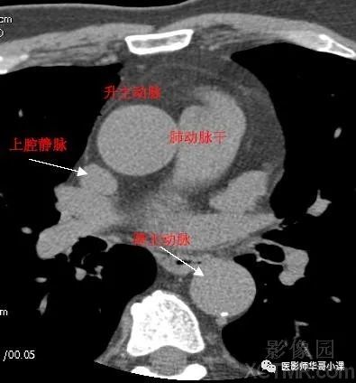 【高清ct图】心脏冠脉cta解剖