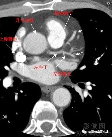 【高清ct图】心脏冠脉cta解剖