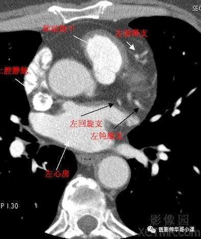 【高清ct图】心脏冠脉cta解剖