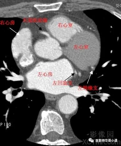【高清ct图】心脏冠脉cta解剖