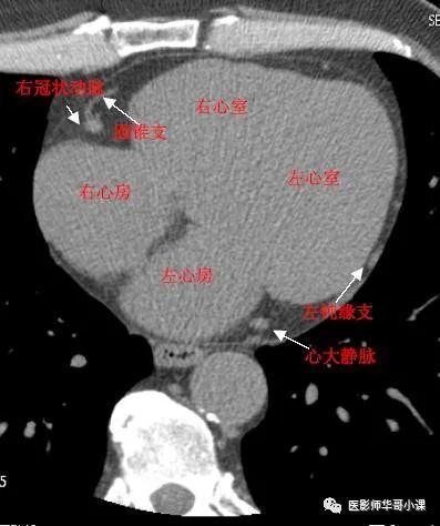 【高清ct图】心脏冠脉cta解剖
