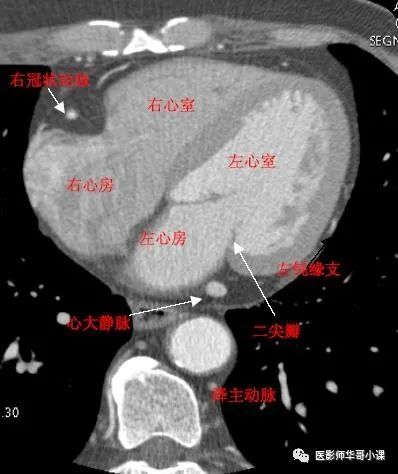 【高清ct图】心脏冠脉cta解剖